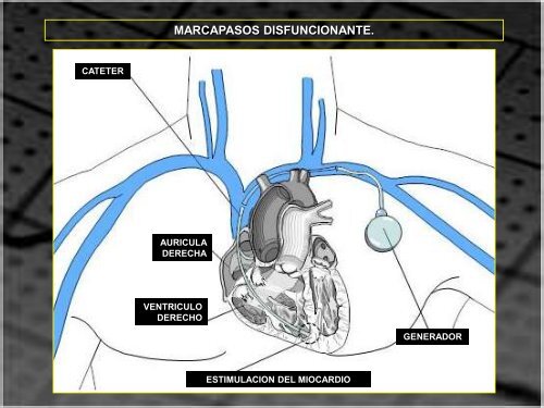 MARCAPASOS DISFUNCIONANTE. TIPOS DE ... - SEMM