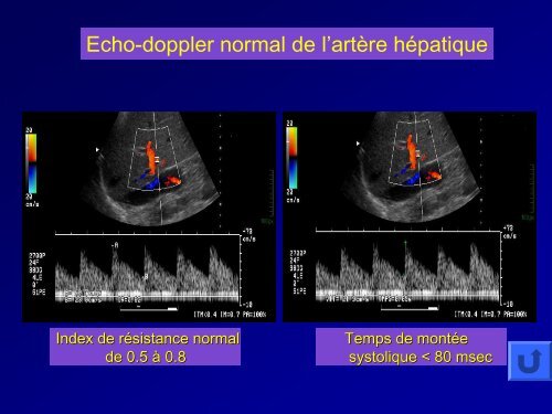 imageries des complications post-opÃ©ratoires dans les ...