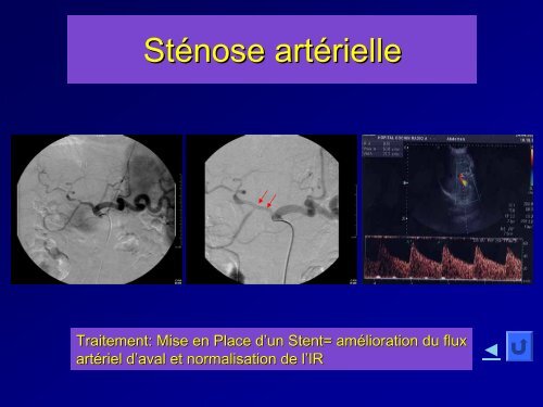 imageries des complications post-opÃ©ratoires dans les ...