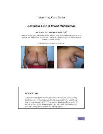 Abnormal Case of Breast Hypertrophy - ePlasty