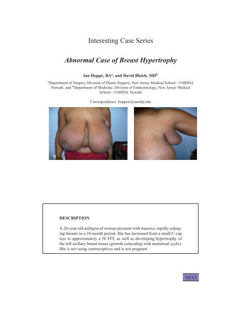 Picture of hypertrophy of breast