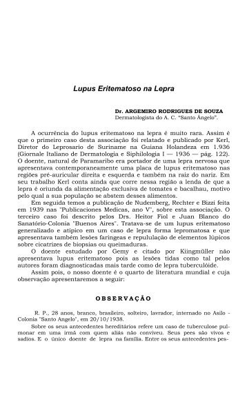 Lupus Eritematoso na Lepra
