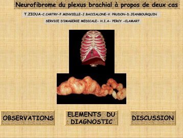 Neurofibrome du plexus brachial Ã  propos de deux cas ELEMENTS ...