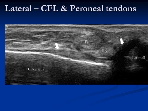 Diagnostic Ultrasound of the Ankle and Foot