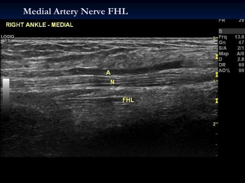 Diagnostic Ultrasound of the Ankle and Foot