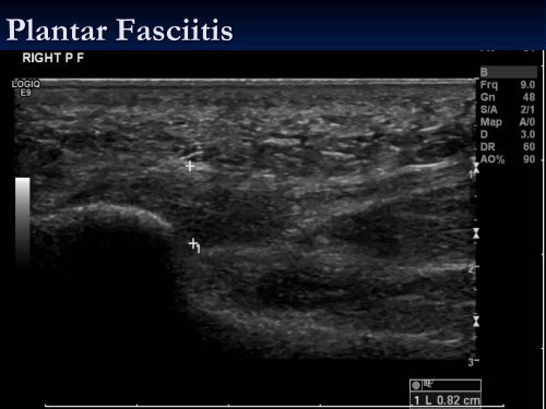 Diagnostic Ultrasound of the Ankle and Foot