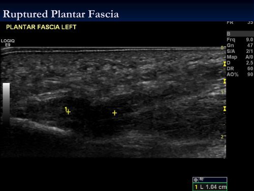 Diagnostic Ultrasound of the Ankle and Foot