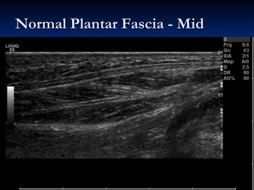 Diagnostic Ultrasound of the Ankle and Foot