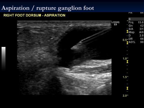 Diagnostic Ultrasound of the Ankle and Foot