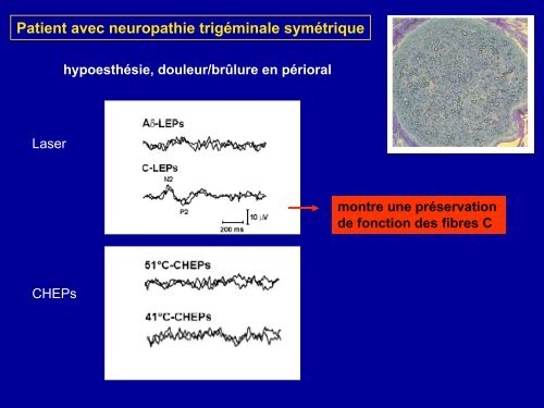 Exploration de la sensibilitÃ© thermo-algÃ©sique par les Potentiels ...