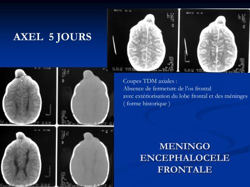 Kystes et fistules de la rÃ©gion fronto-nasale mÃ©diane