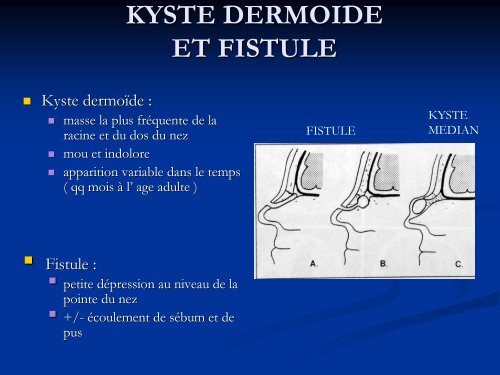 Kystes et fistules de la rÃ©gion fronto-nasale mÃ©diane