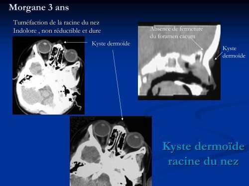 Kystes et fistules de la rÃ©gion fronto-nasale mÃ©diane