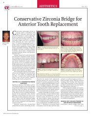 Conservative Zirconia Bridge for Anterior Tooth Replacement