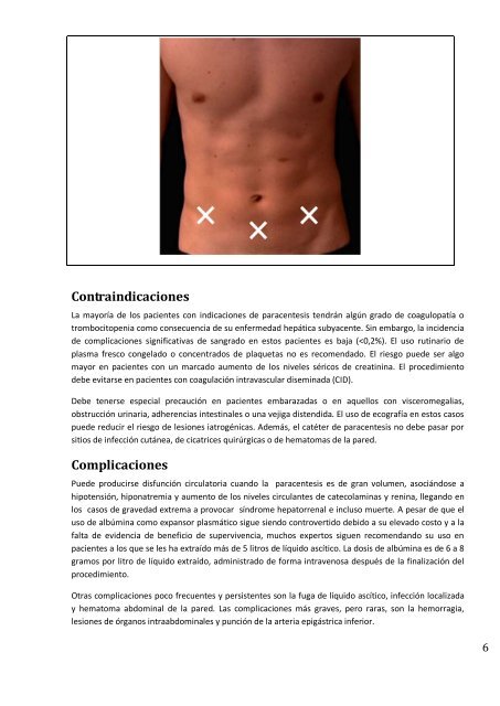 Complicaciones crÃ³nicas de la cirrosis hepÃ¡tica: ascitis y peritonitis ...