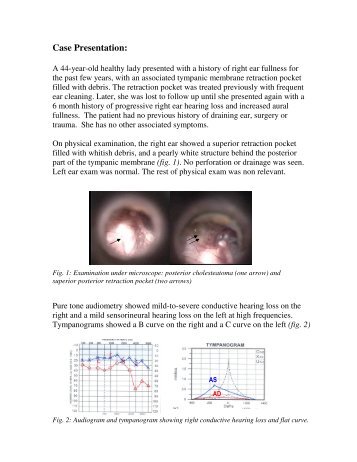 Primary Acquired Cholesteatoma