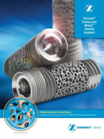 Trabecular Metal Technology - Zimmer Dental