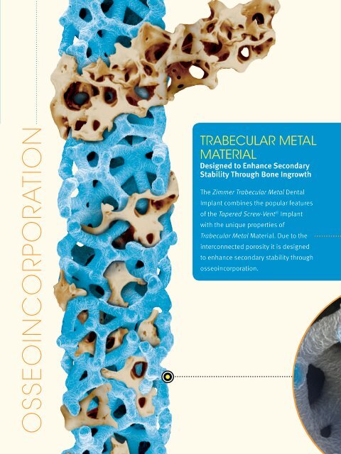 Trabecular Metal Technology - Zimmer Dental