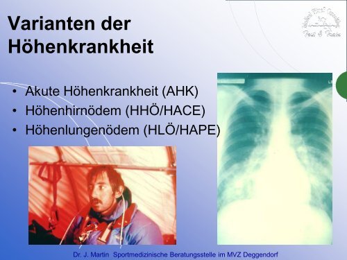 High Altitude Pulmonary Edema - HAPE