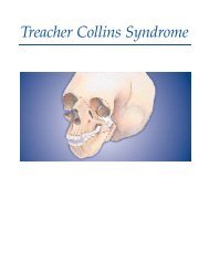 Treacher Collins Syndrome - Erlanger Health System