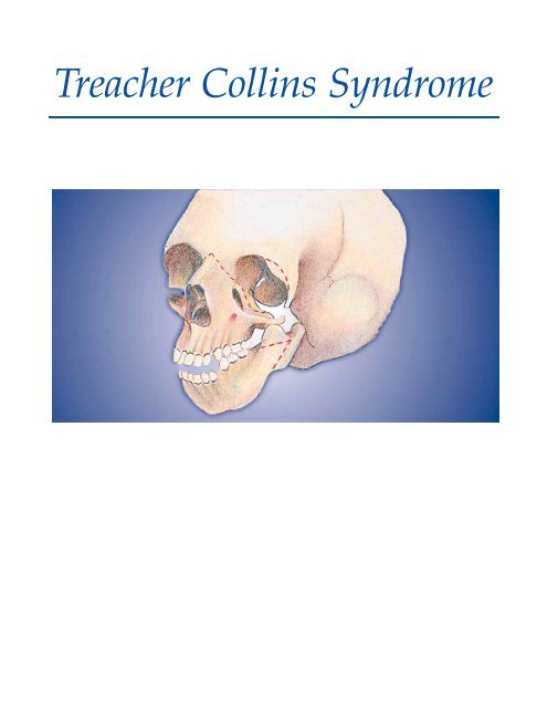 Treacher Collins Syndrome - Erlanger Health System