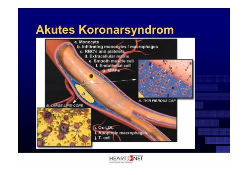 Akutes Koronarsyndrom - Scopri.ch