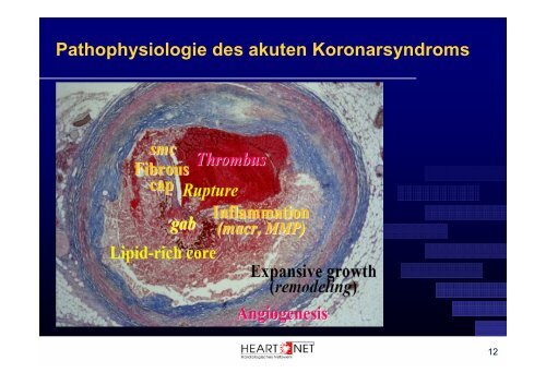 Akutes Koronarsyndrom - Scopri.ch