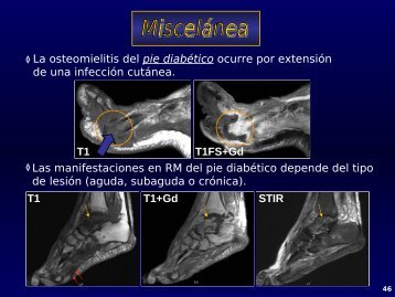 Miscelánea: fascitis plantar