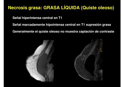 Necrosis grasa: GRASA LÍQUIDA (Quiste oleoso)