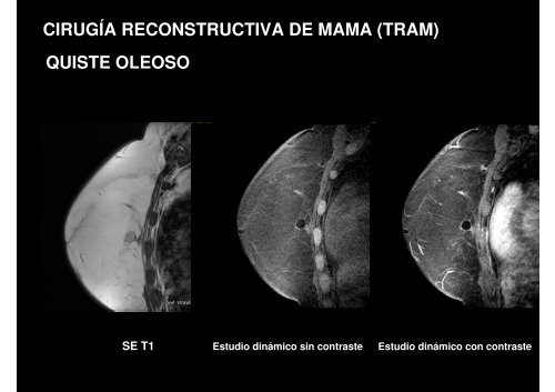 Necrosis grasa: GRASA LÍQUIDA (Quiste oleoso)