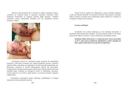 PARTEA I - TRAUMATOLOGIE FRACTURI ... - OvidiusMD