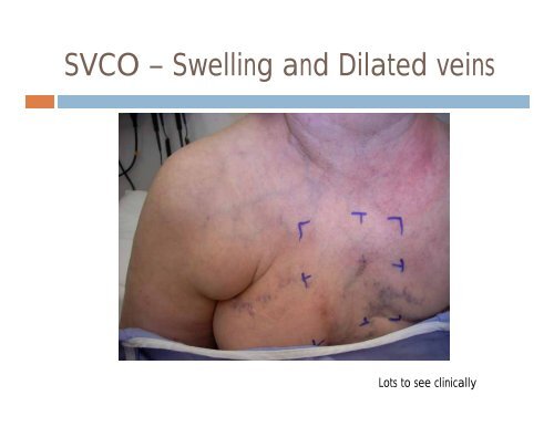 Spinal Cord Compression Superior Vena Cava Obstruction