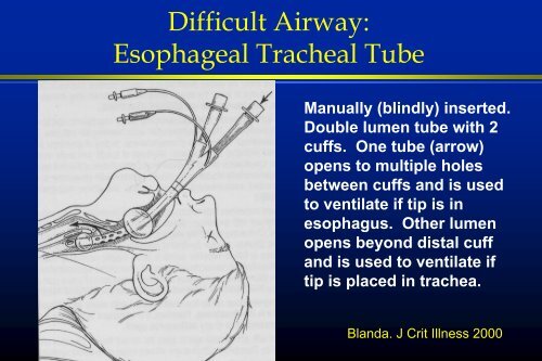 Endotracheal Intubation - Virginia Commonwealth University