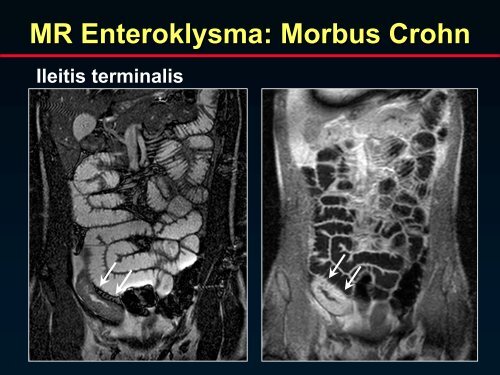 MR Enteroklysma - gastroenterologie-wintertreffen.at