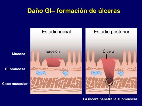 Manejo Racional de Anti Inflamatorios No Esteroidales (AINES)