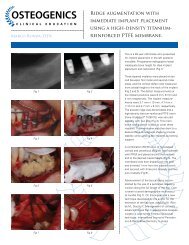 Ridge augmentation with immediate implant ... - Osteogenics