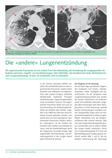 Organisierende Pneumonie: die "andere" LungenentzÃ¼ndung - CHUV