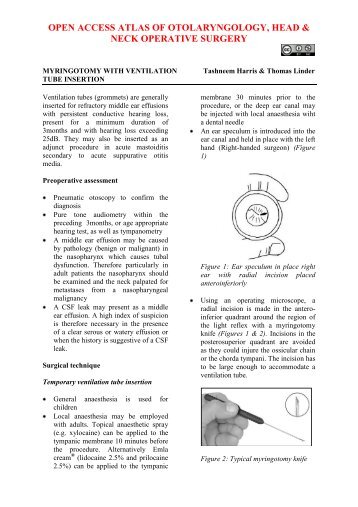 Myringotomy and Ventilation tube insertion - Vula - University of ...