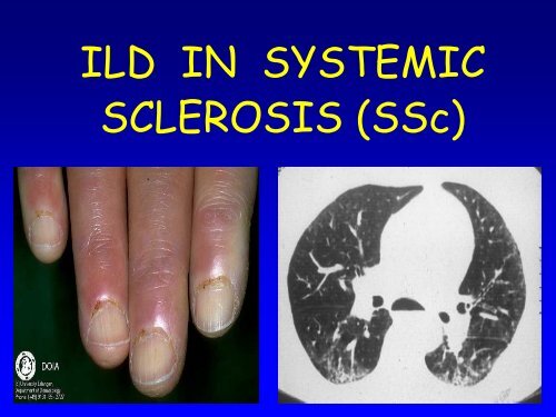 Collagen vascular disease in the lungs