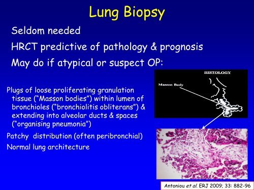 Collagen vascular disease in the lungs