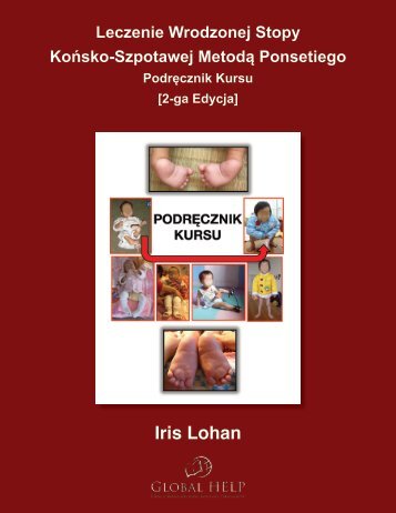 zarys leczenia stopy koÅsko-szpotawej metodÄ ... - Global HELP