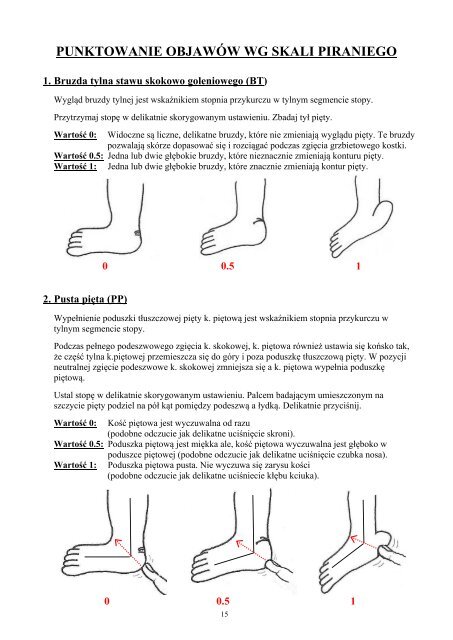 zarys leczenia stopy koÅsko-szpotawej metodÄ ... - Global HELP