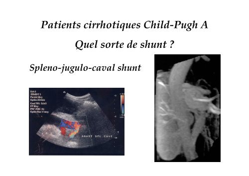 Hypertension portale - SOFOP