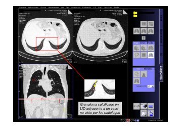 Granuloma calcificado en LID d t LID adyacente a un vaso no visto ...