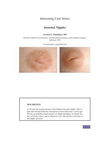 Interesting Case Series Inverted Nipples - ePlasty