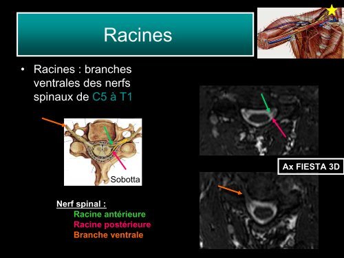 Imagerie du plexus brachial normal et pathologique