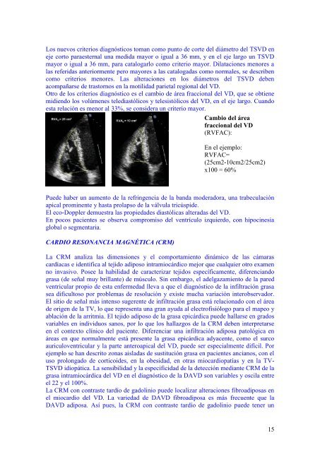 Displasia arritmogÃ©nica del ventrÃ­culo derecho - cardiomil.com.uy