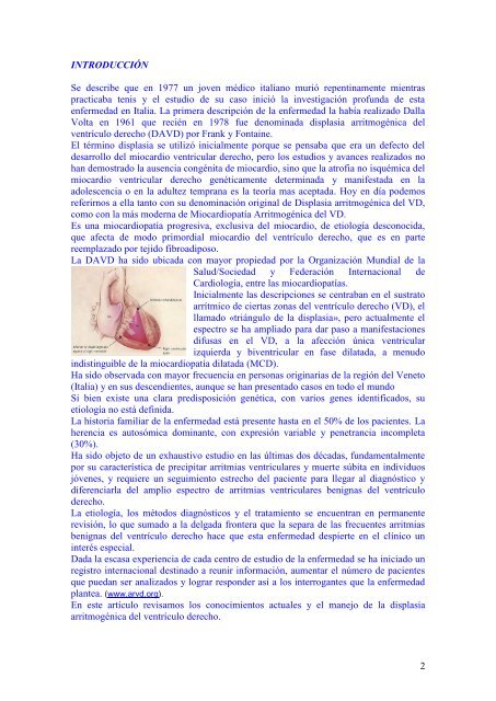 Displasia arritmogÃ©nica del ventrÃ­culo derecho - cardiomil.com.uy