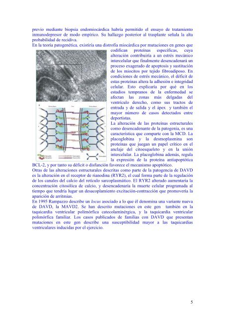 Displasia arritmogÃ©nica del ventrÃ­culo derecho - cardiomil.com.uy