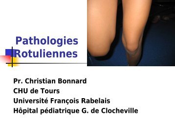 Pathologie Rotulienne - Ch Bonnard - SOFOP